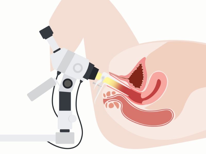 soi-co-tu-cung-la-gi-1