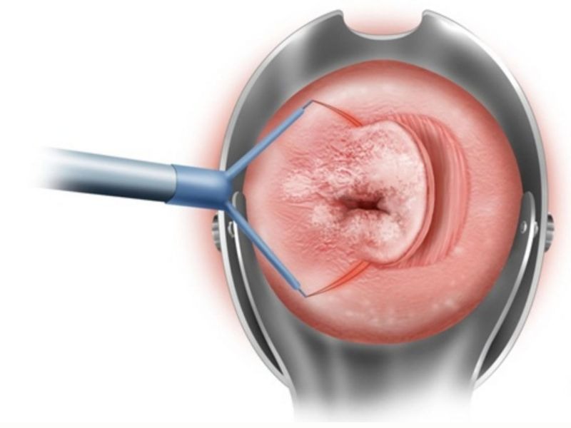 khoet-chop-co-tu-cung-bang-vong-dien-nhiet-1