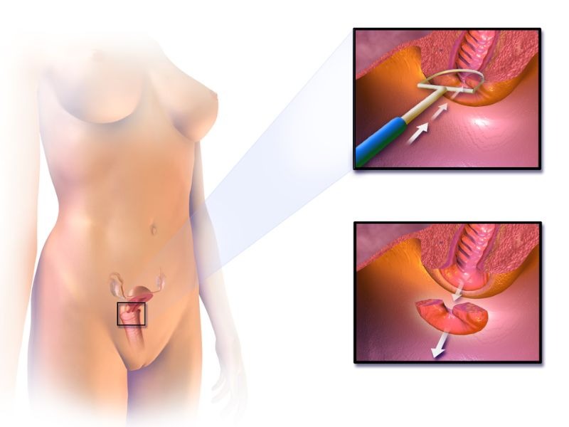 khoet-chop-co-tu-cung-bang-vong-dien-nhiet-4