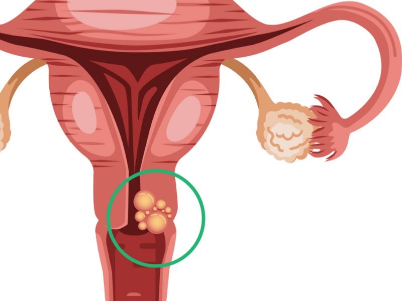 khoet-chop-co-tu-cung-bang-vong-dien-nhiet-2