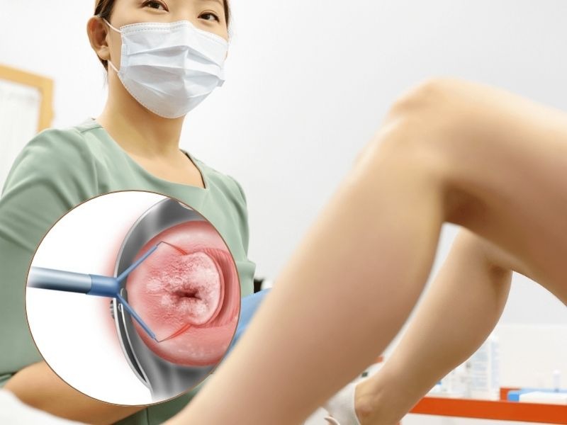 chi-phi-khoet-chop-co-tu-cung-1