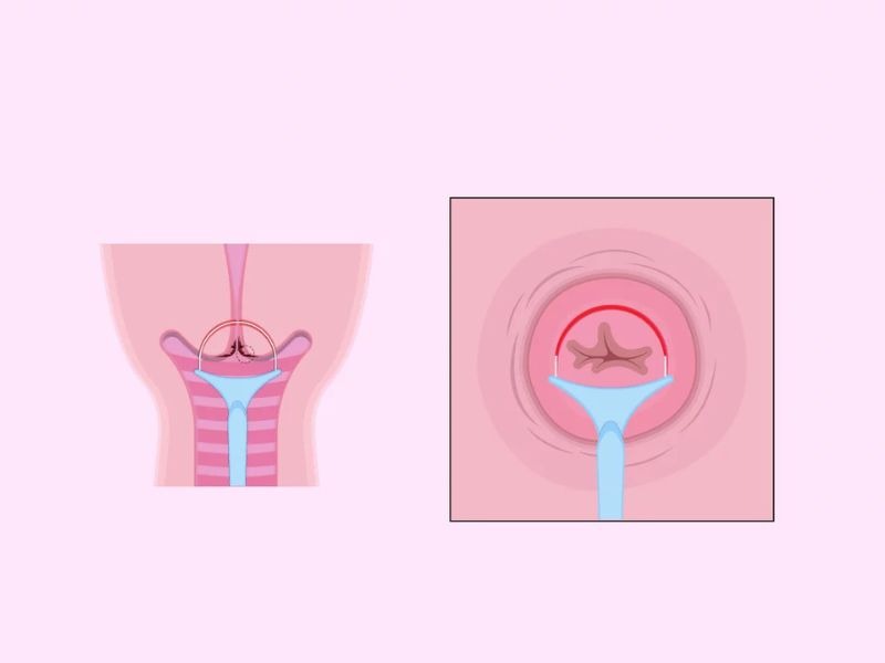 sau-khoet-chop-co-tu-cung-co-trieu-chung-gi-1