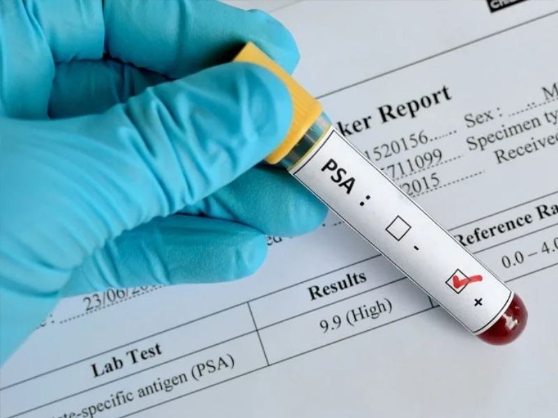 dinh-luong-psa-toan-phan-1