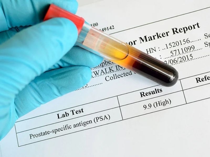 dinh-luong-psa-toan-phan-3