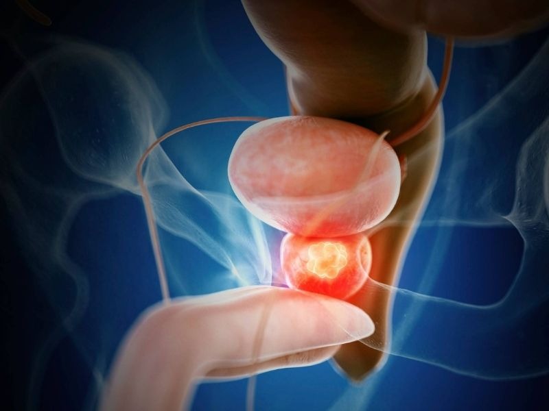 cach-lam-giam-chi-so-psa-1