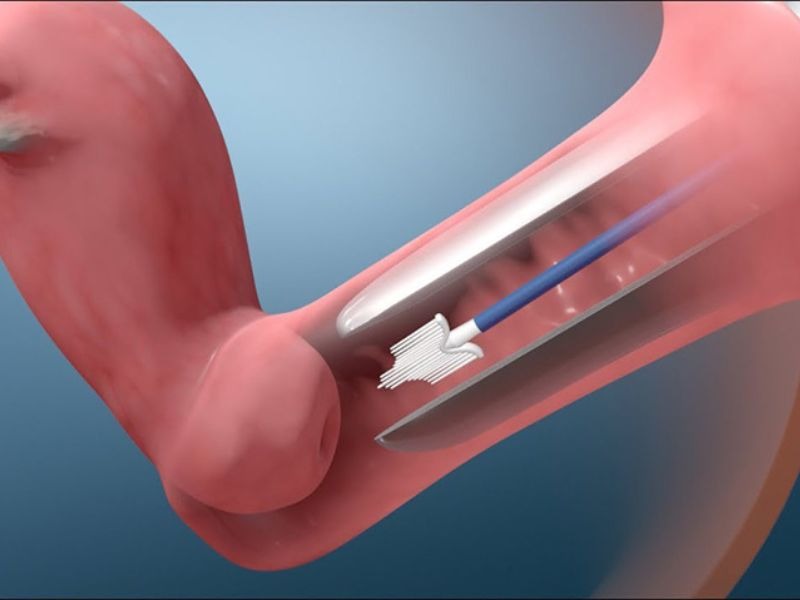 ung-thu-co-tu-cung-khi-mang-thai-3