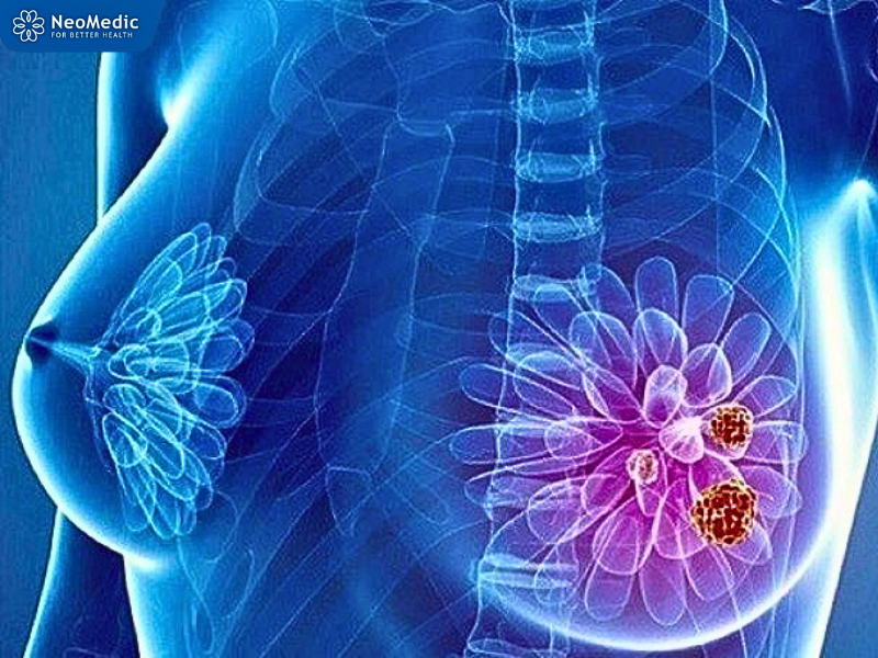 tam-soat-ung-thu-bao-lau-1-lan-2