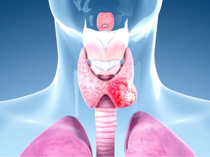 xet-nghiem-ung-thu-tuyen-giap-6