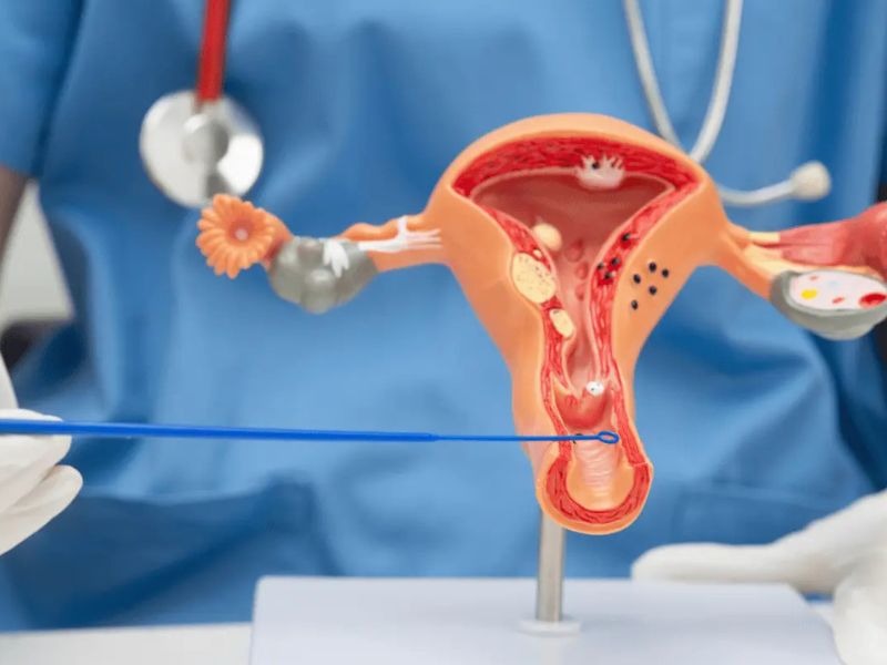 ung-thu-co-tu-cung-giai-doan-cuoi-3