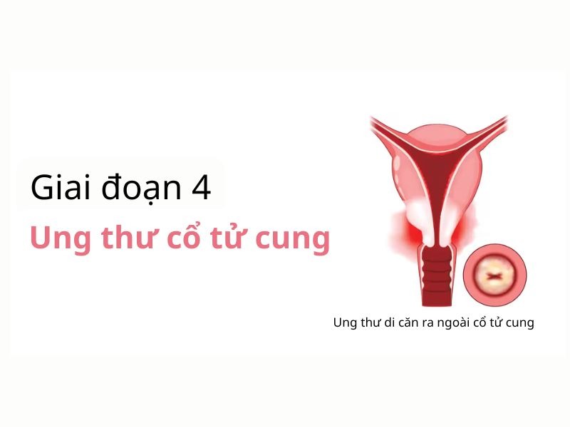 ung-thu-co-tu-cung-giai-doan-cuoi-1