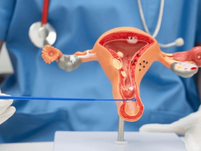 sinh-thiet-co-tu-cung-2