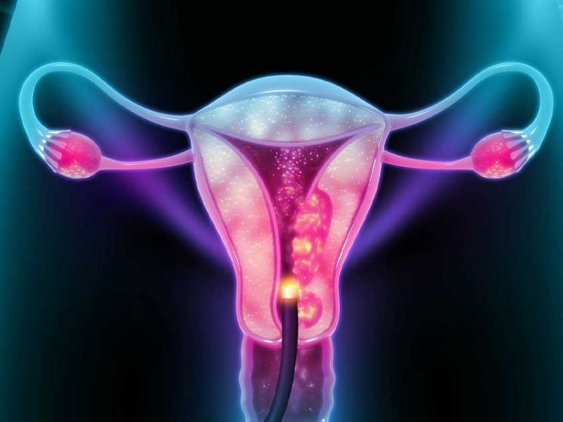 ung-thu-co-tu-cung-giai-doan-cuoi-4