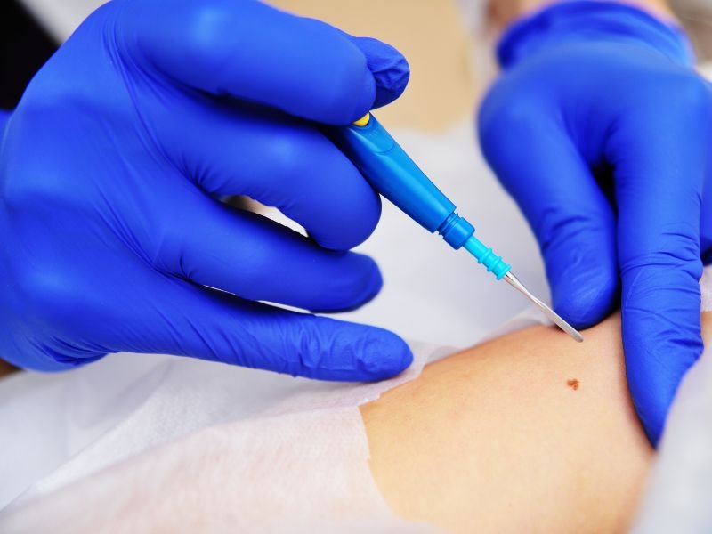 sinh-thiet-bao-lau-co-ket-qua-1