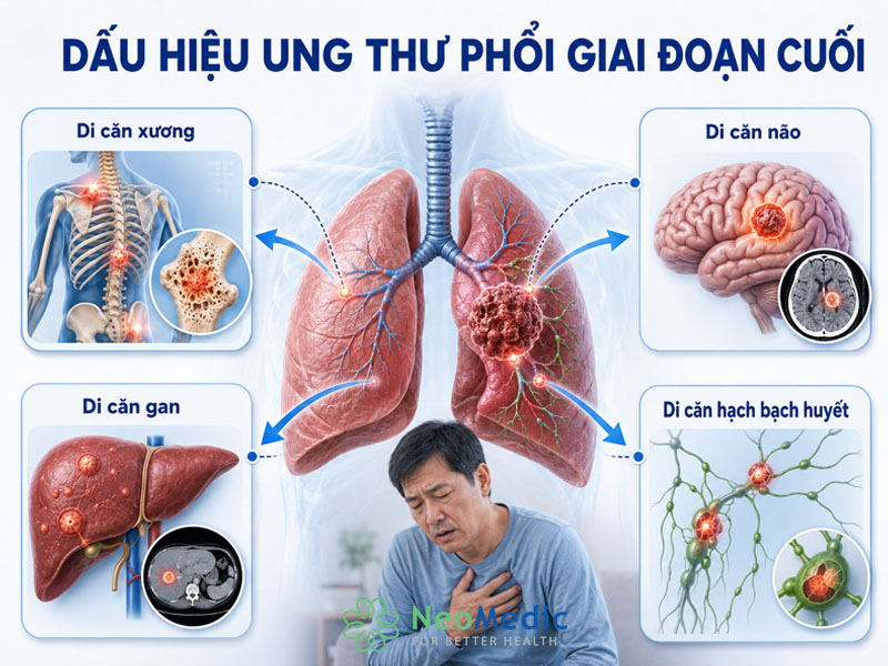 dau-hieu-ung-thu-phoi-giai-doan-cuoi