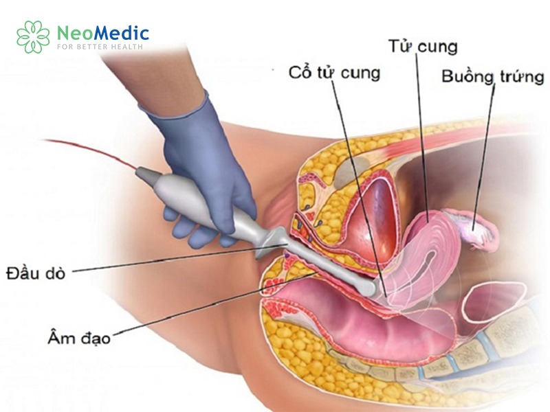 kham-thai-lan-dau-co-can-sieu-am-dau-do-khong