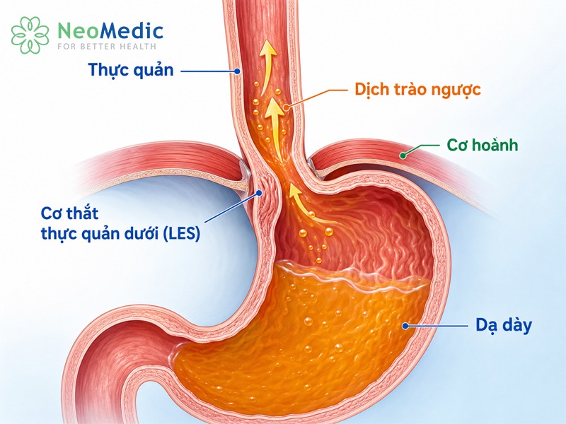 trao-nguoc-da-day-thuc-quan