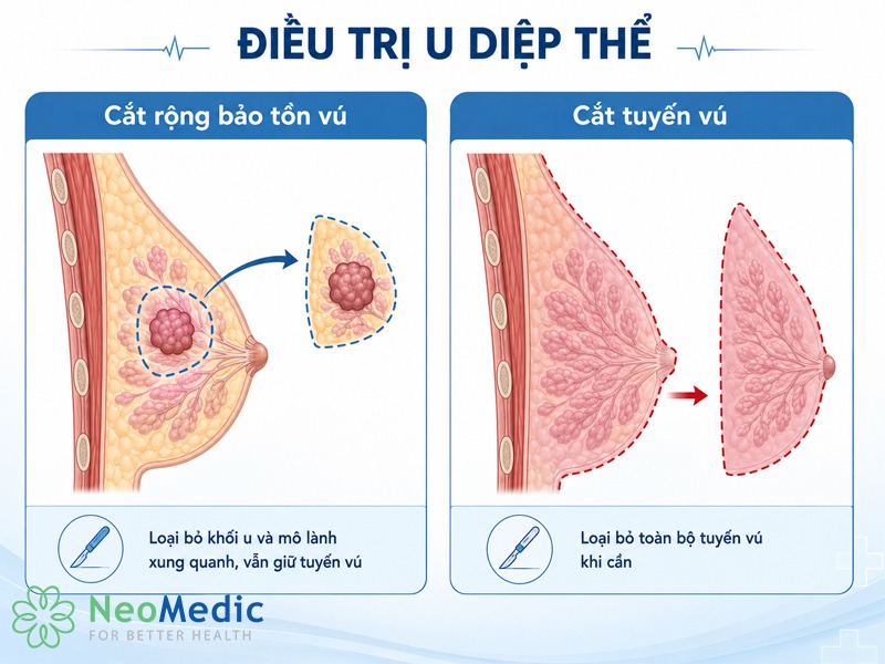 dieu-tri-u-diep-the-tuyen-vu