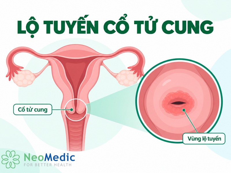 lo-tuyen-co-tu-cung