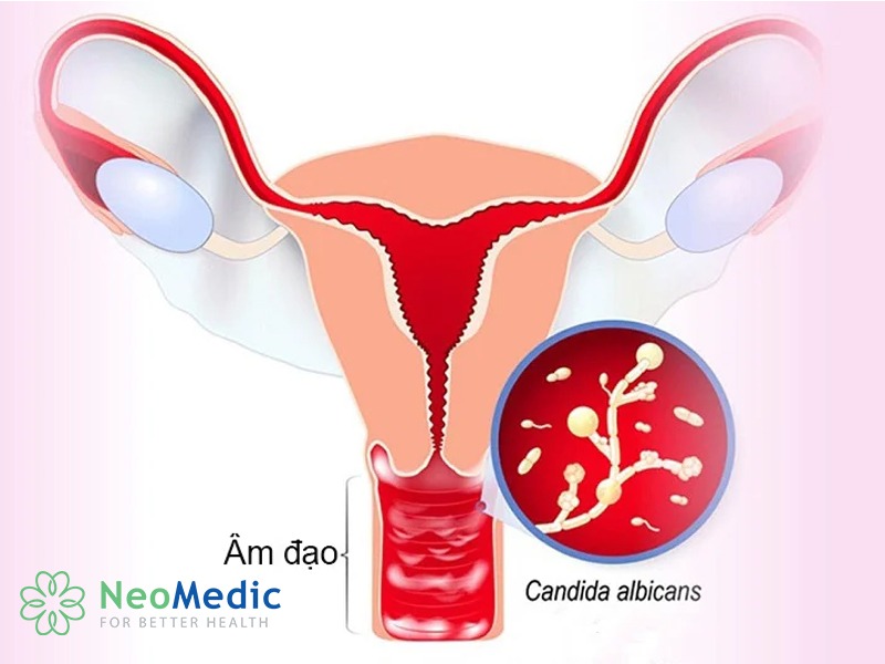 viem-am-dao-viem-do-candida