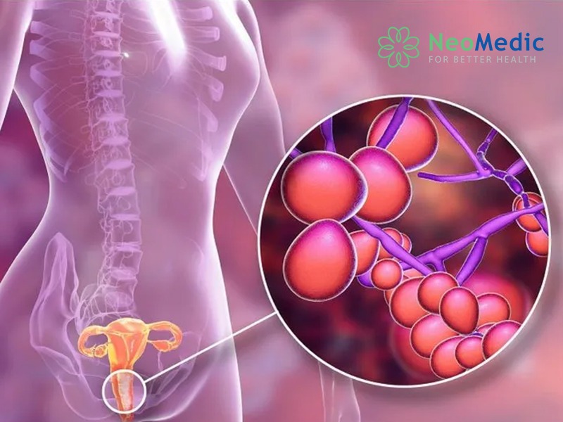 viem-am-dao-do-candida