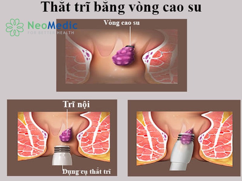benh-tri-that-vong-cao-su