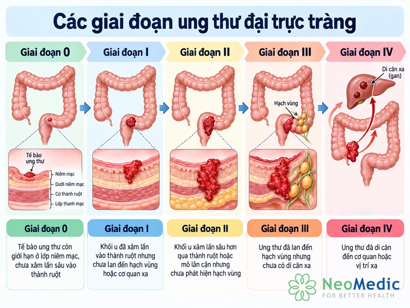 giai-doan-ung-thu-dai-truc-trang