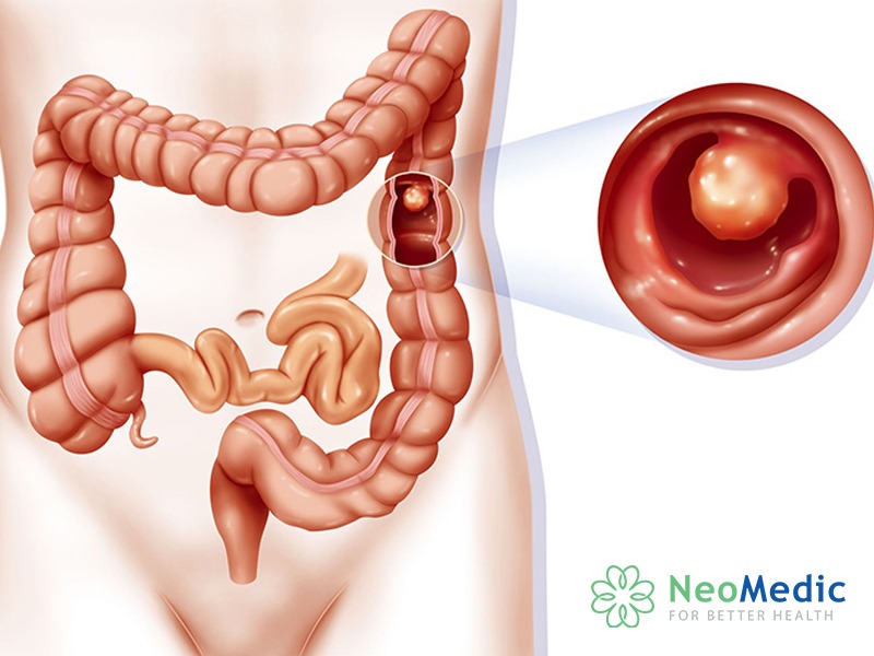 di-ngoai-ra-mau-polyp