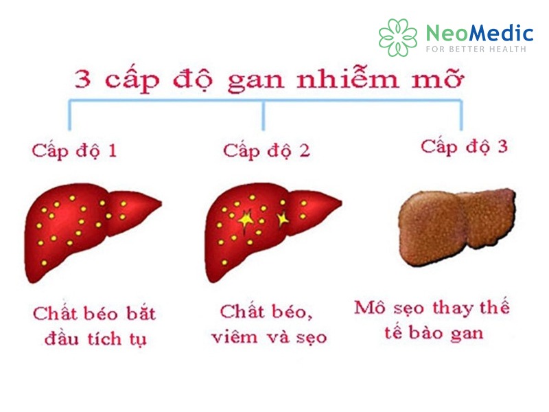 gan-nhiem-mo-do-1-cap-do