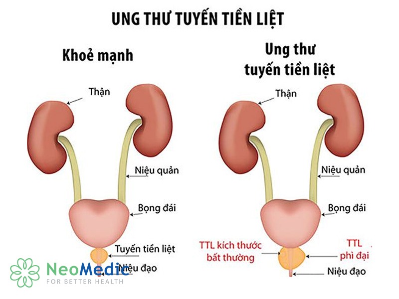 xet-nghiem-gen-brca-ung-thu-tuyen-tien-liet