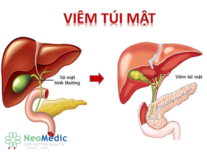 polyp-tui-mat-do-viem-tui-mat