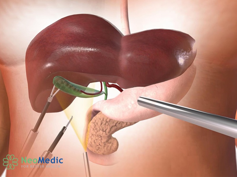 phau-thuat-polyp-tui-mat