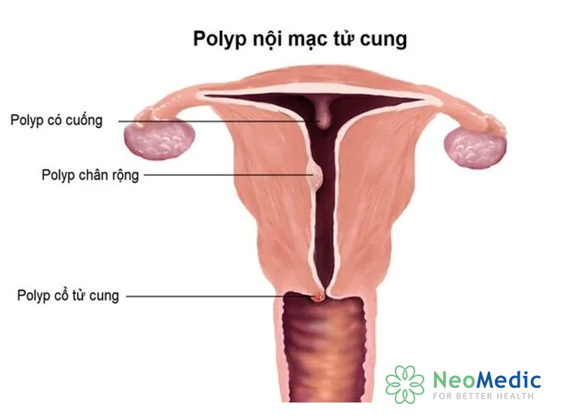 ra-mau-sau-man-kinh-polyp-noi-mac
