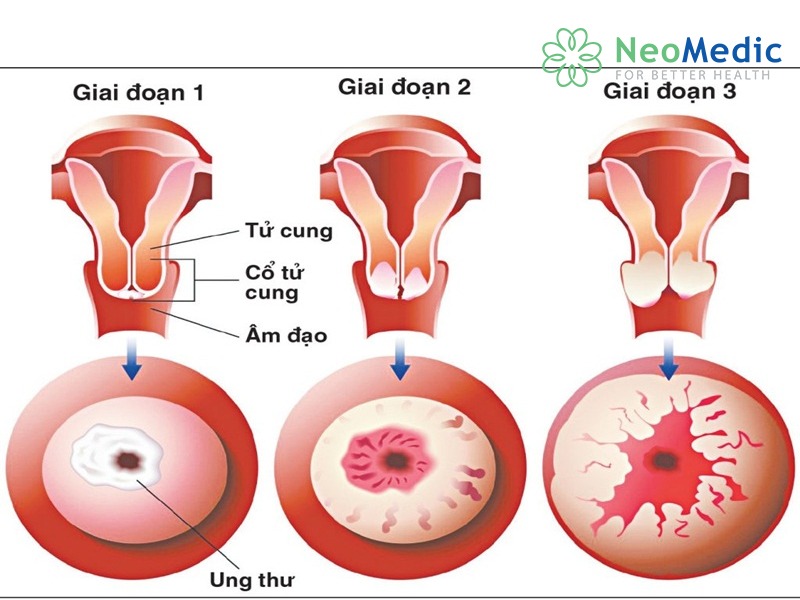 HPV-duong-tinh-khong-ket-luan-ung-thu