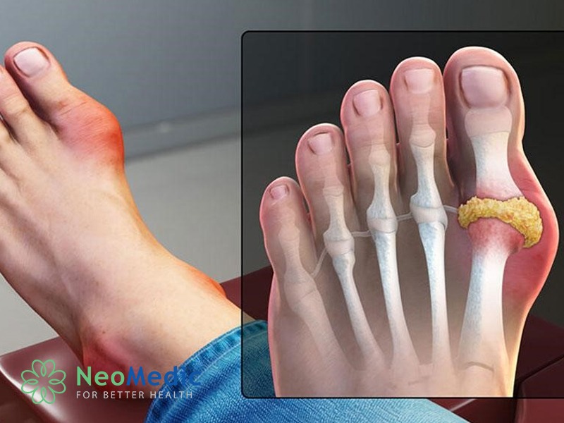 axit-uric-cao-tien-trien-thanh-gout