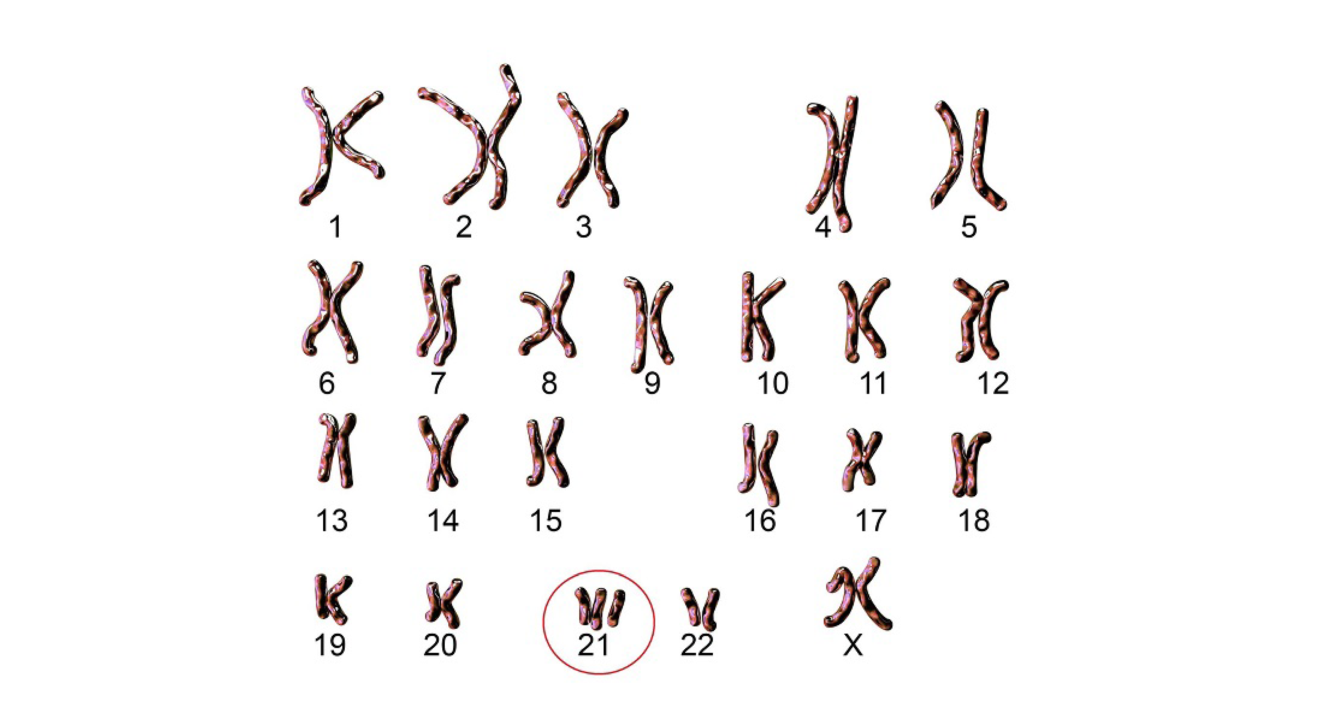 hoi-chung-down-la-gi-cac-cach-phat-hien-som-1