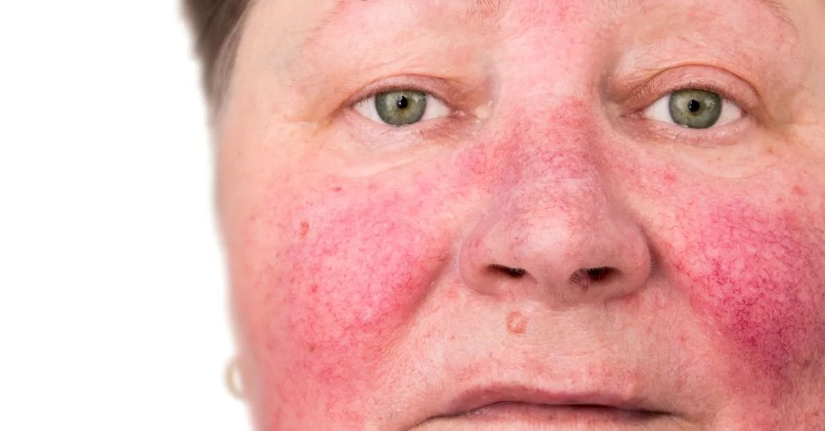 hoi-chung-Carcinoid-1