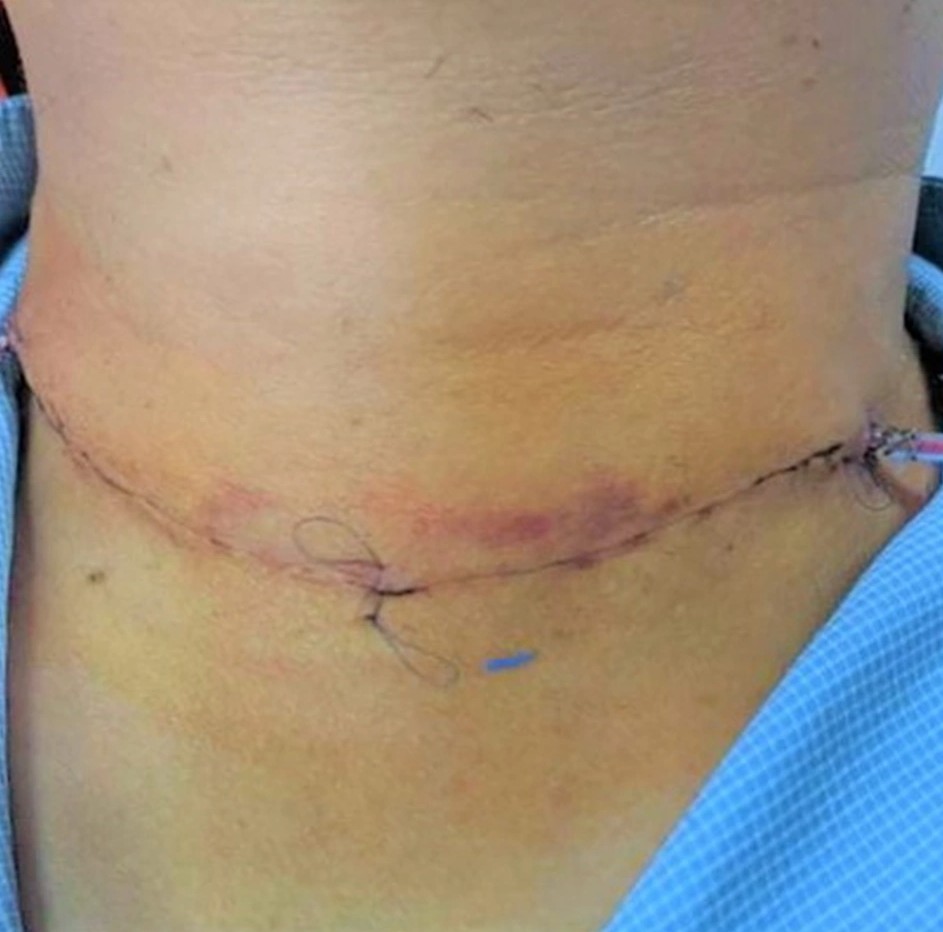 cham-soc-sau-mo-ung-thu-tuyen-giap-1