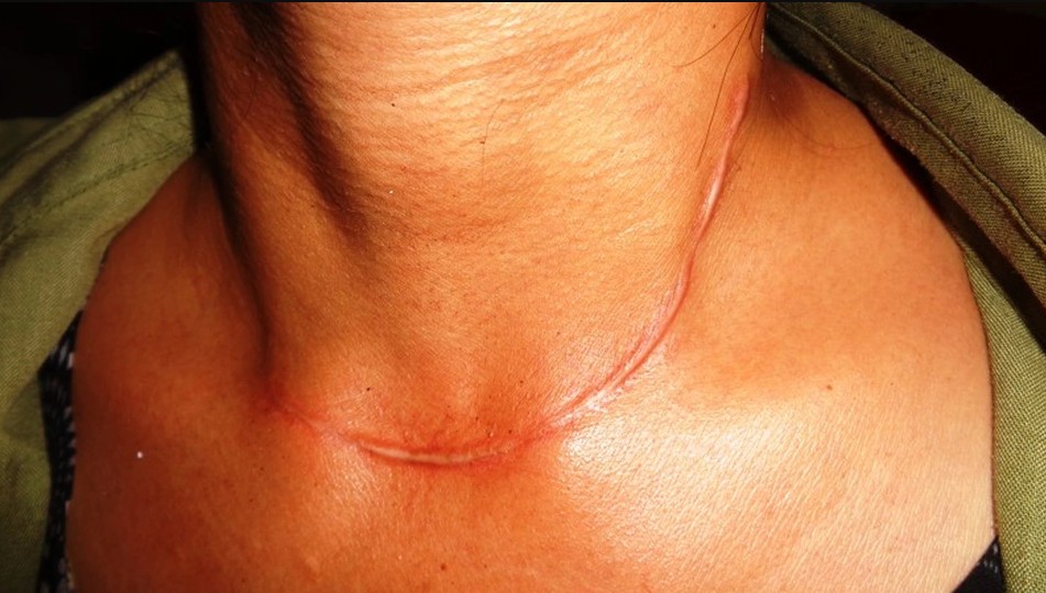 ung-thu-tuyen-giap-giai-doan-cuoi-1