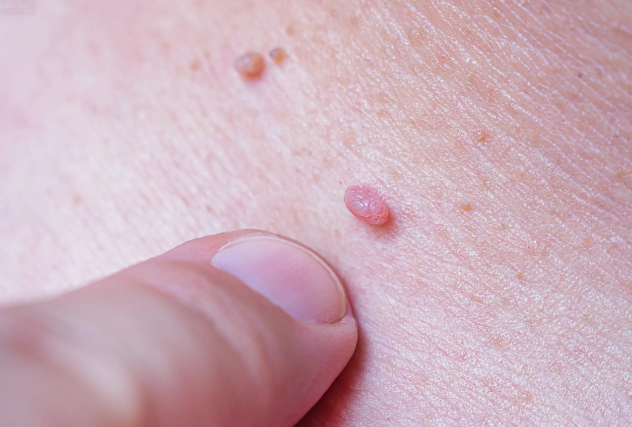 HPV-dac-diem-nguy-co-nhiem-phan-loai-3