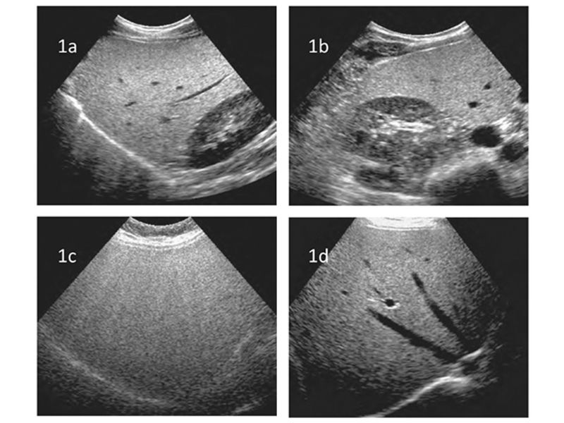 sieu-am-gan-nhiem-mo-4
