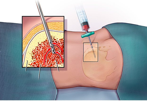 sinh-thiet-xuong-la-gi-2