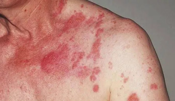 hoi-chung-Carcinoid-2