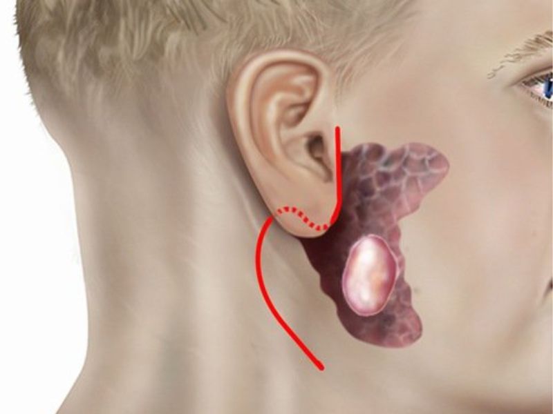 sieu-am-tuyen-nuoc-bot-mang-tai-4