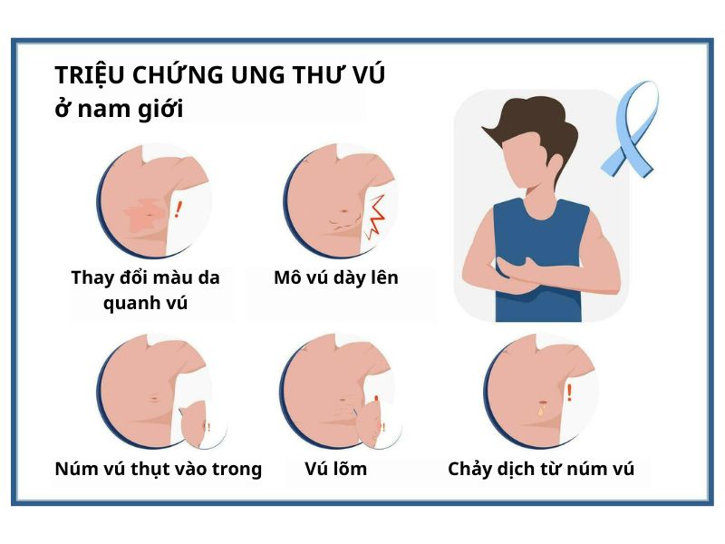ung-thu-vu-o-nam-gioi-4