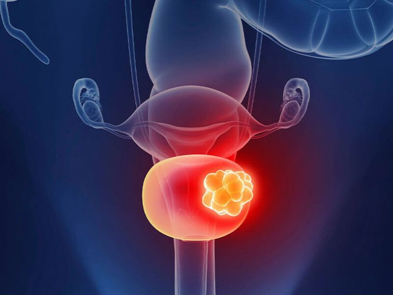 sieu-am-co-phat-hien-ung-thu-bang-quang-2