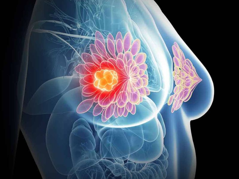 ung-thu-vu-song-duoc-bao-lau-2