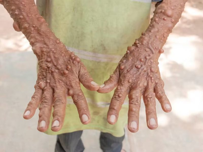 u-xo-than-kinh-la-gi-4