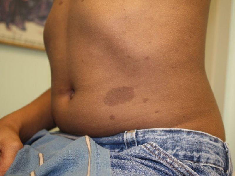 u-xo-than-kinh-la-gi-6