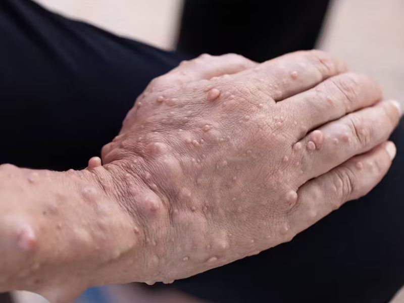 u-xo-than-kinh-la-gi-3