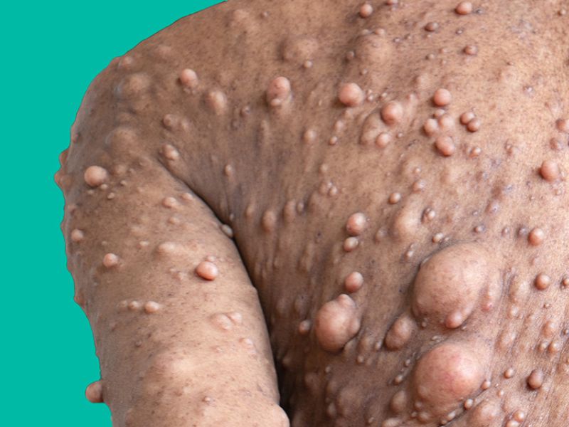 u-xo-than-kinh-la-gi-2